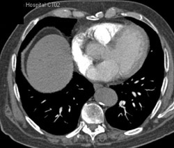 Poor Cardiac Output - CTisus CT Scan