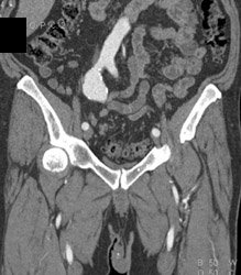 Iliac Artery Aneurysm - CTisus CT Scan