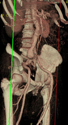 Common Iliac Artery Aneurysm - CTisus CT Scan