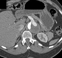 Dissection Extends Into SMA - CTisus CT Scan