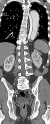 Aortic Dissection - CTisus CT Scan