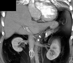 Inferior Vena Cava (IVC) Filter - CTisus CT Scan