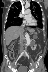 Incidental Abdominal Aortic Aneurysm (AAA) - CTisus CT Scan