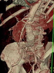 Abdominal Aortic Aneurysm (AAA) - CTisus CT Scan