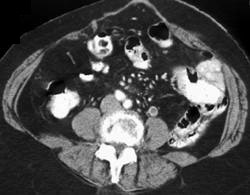 Thrombosed Left Gonadal Vein - CTisus CT Scan