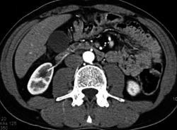 Normal Renal Artery - CTisus CT Scan