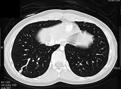 Pulmonary Arteriovenous Malformation (PAVM) - CTisus CT Scan