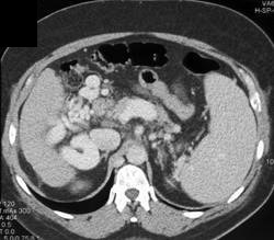 Cavernous Transformation of the Portal Vein (CTPV) With Huge Varices - CTisus CT Scan