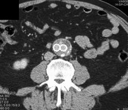 Endoleak - CTisus CT Scan