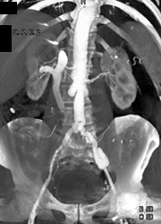 Unusual Focal Aneurysms - CTisus CT Scan