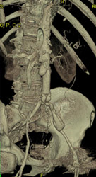 Unusual Focal Aneurysms at Site of Aneurysm Repair - CTisus CT Scan