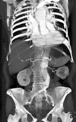 Aortic Dissection - CTisus CT Scan