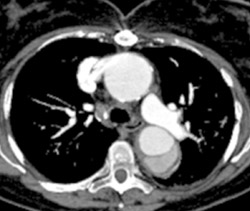 Aortic Dissection - CTisus CT Scan