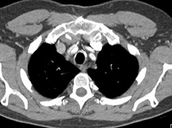 Aortic Dissection Into Arch Vessel - CTisus CT Scan