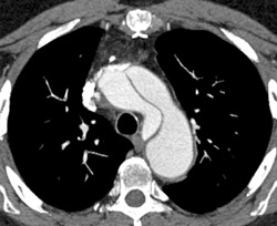 Aortic Dissection Which Involves the Left Renal Artery - CTisus CT Scan