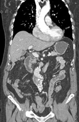 Endoleak - CTisus CT Scan