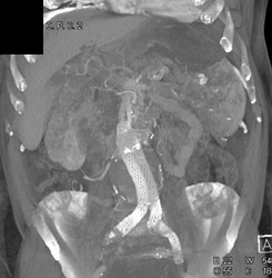 Endoleak - CTisus CT Scan