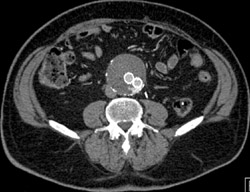 Endoleak - Vascular Case Studies - CTisus CT Scanning