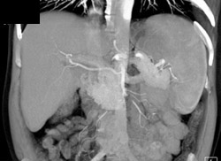 Replaced Right Hepatic Artery Off SMA - CTisus CT Scan