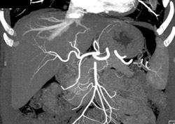 Normal Celiac and SMA - CTisus CT Scan