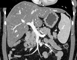 Normal Portal Vein - CTisus CT Scan