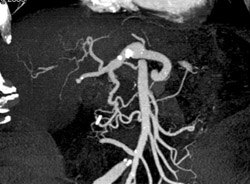 Plaque in Celiac Artery - CTisus CT Scan