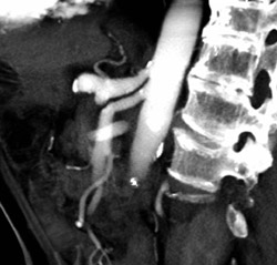 Minimal Narrowing Origin of the Celiac Artery - CTisus CT Scan