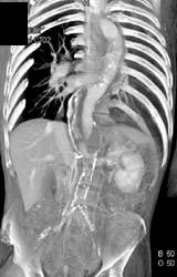 Aortic Dissection - CTisus CT Scan