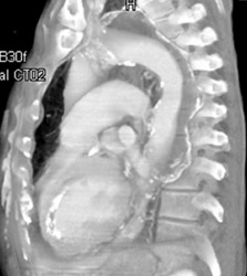 Aortic Aneurysm With Plaque - CTisus CT Scan