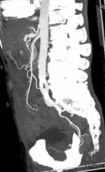 Normal SMA With Celiac Artery Aneurysm - CTisus CT Scan