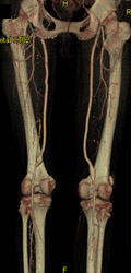 CTA of Thighs - CTisus CT Scan