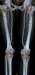 CTA With Disease Beneath Popliteals - CTisus CT Scan