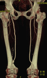 Femoral-popliteal Grafts - CTisus CT Scan