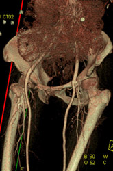 CTA Pelvis at Graft Site - CTisus CT Scan