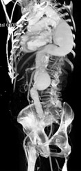 Abdominal Aortic Aneurysm (AAA) and Thoracic Aneruysm - CTisus CT Scan