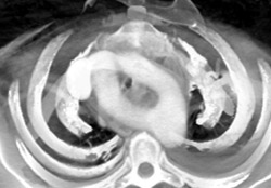 Double Aortic Arch - CTisus CT Scan