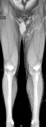 Collaterals in Left Thigh - CTisus CT Scan