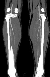 Trifurcation on CTA With MIP - CTisus CT Scan