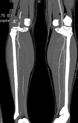 Trifurcation at Knee - CTisus CT Scan