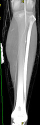 Trifurcation With VRT - CTisus CT Scan