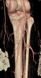 Ct Angiogram of Normal Trifurcation - CTisus CT Scan