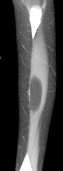 Lipoma - CTisus CT Scan