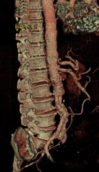 Diseased Celiac Artery With Stenosis - CTisus CT Scan