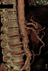 Diseased Celiac and Aorta - CTisus CT Scan