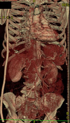 Axillary-femoral Bypass Grafts - CTisus CT Scan