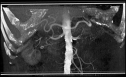 Plaque in Both Renal Arteries - CTisus CT Scan