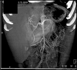 Normal Gastroduodenal Artery (GDA) - CTisus CT Scan