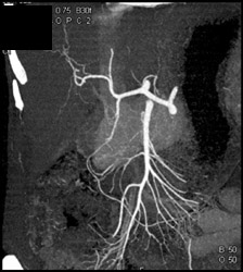 Normal Celiac Artery and SMA - CTisus CT Scan