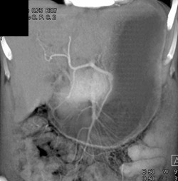 Normal SMA and Celiac Artery - CTisus CT Scan