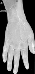 Normal Hand - CTisus CT Scan